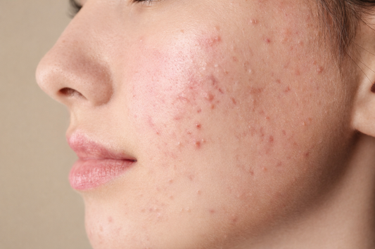 Why Is My Skin Suddenly Breaking Out?