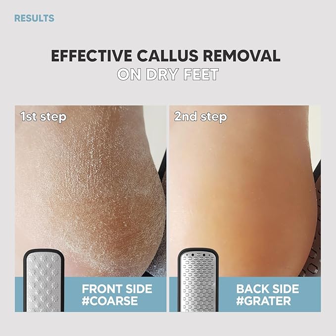 2Steps Stainless Steel Callus Remover, Effective for Thick Callus and Cracked Feet Pedicure Rasp, Remove Hard Skin, Grater Foot File, Foot Scrubber, Professional Foot Care